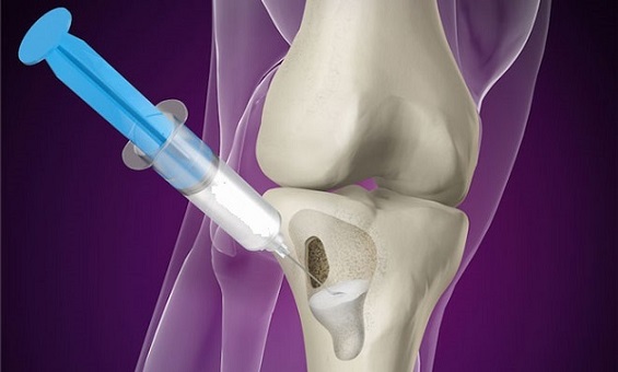 Bone Growth Injection