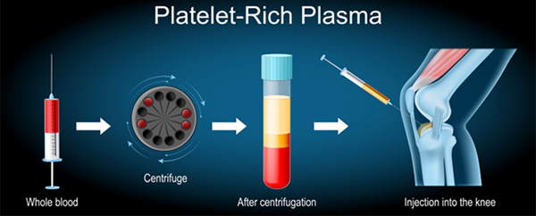 PRP Treatment